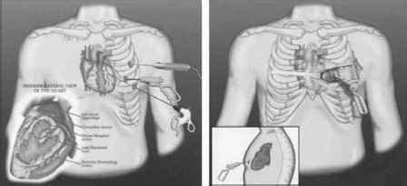 surgical epicardial lead placement.